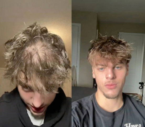 RootX Labs  Microinfuse Hair Regrowth System™